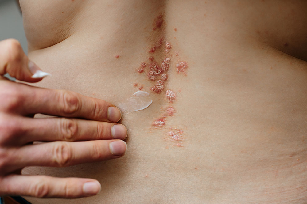 5 Gentle Cleansers for Eczema